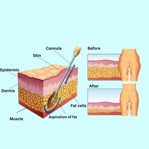 How Liposuction Works ?