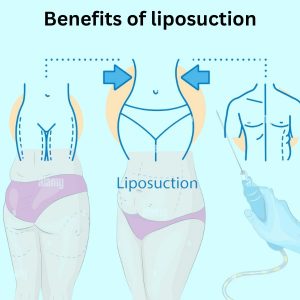 Benefits of liposuction
