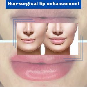 Non-surgical lip enhancement