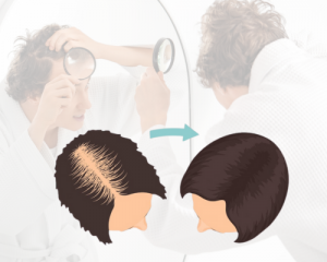 Hair-Transplant-For-Women