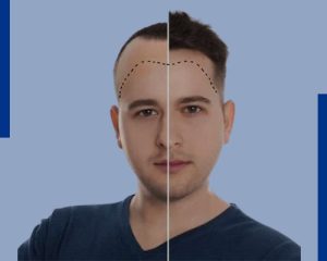 Best Hair Transplant Treatment In Kolkata