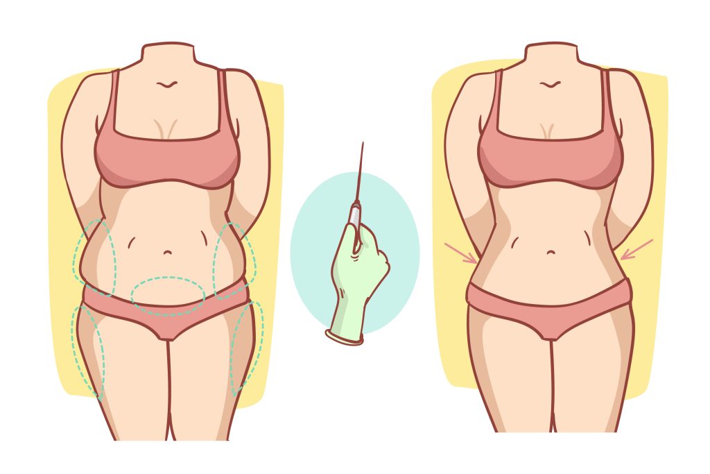 Mommy makeover before and after illustration showing tummy tuck and body contouring results for women in Kolkata.