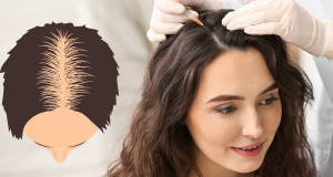 Best Hair Transplant Clinic For Women in Kolkata Hair transplant in Kolkata